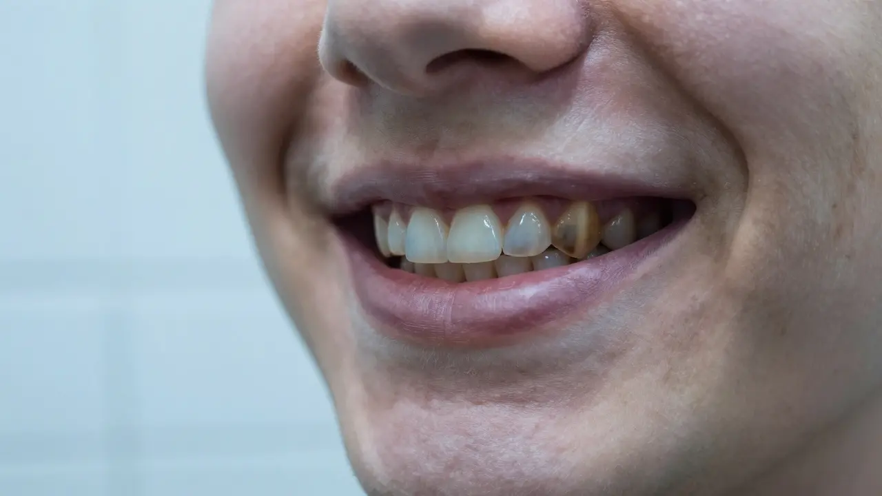 Tetracyklinové zuby: Úplný průvodce estetikou a bělením